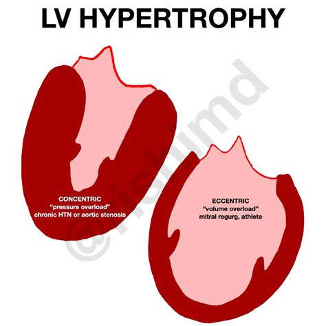 eccentric lv hypertrophy|eccentric vs concentric hypertrophy heart.